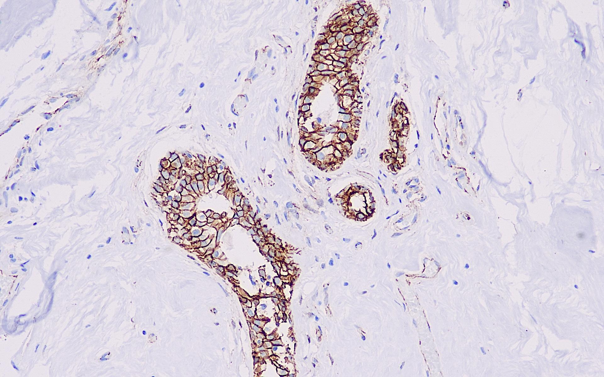 β-catenin 20 乳腺纤维瘤